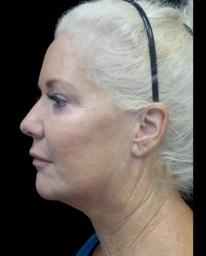 Facelift Before & After Patient #24508