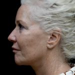 Facelift Before & After Patient #24508