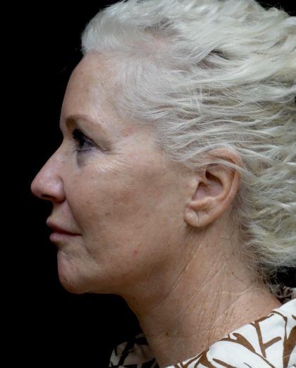 Facelift Before & After Patient #24508
