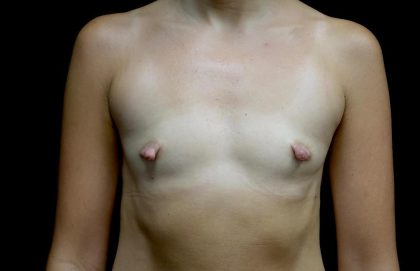 Breast Augmentation (Implants) Before & After Patient #24625