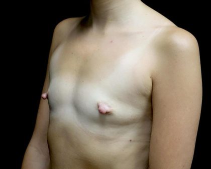 Breast Augmentation (Implants) Before & After Patient #24625