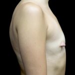 Breast Augmentation (Implants) Before & After Patient #24625