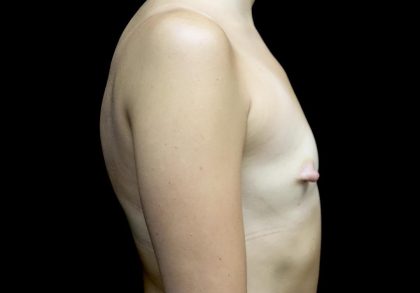 Breast Augmentation (Implants) Before & After Patient #24625