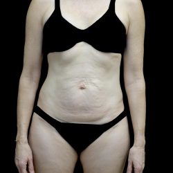 Tummy Tuck Before & After Patient #24618