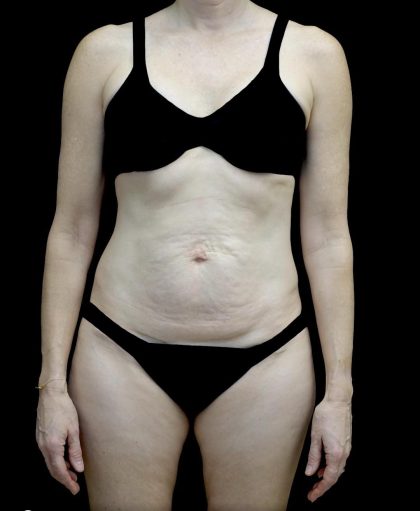 Tummy Tuck Before & After Patient #24618