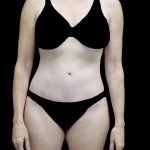 Tummy Tuck Before & After Patient #24618