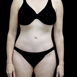 Tummy Tuck Before & After Patient #24618