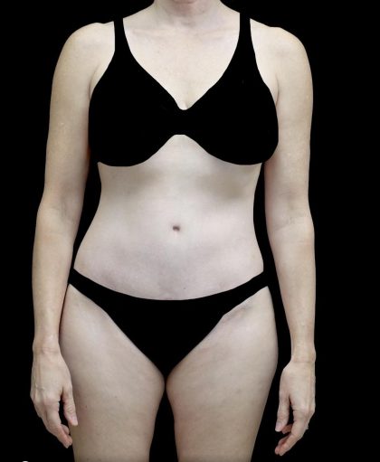 Tummy Tuck Before & After Patient #24618