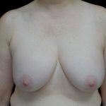 Breast Implant Removal (Explant Surgery) Before & After Patient #24626