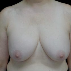Breast Implant Removal (Explant Surgery) Before & After Patient #24626