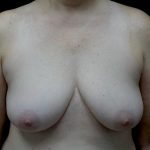 Breast Implant Removal (Explant Surgery) Before & After Patient #24626