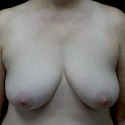 Breast Implant Removal (Explant Surgery) Before & After Patient #24626