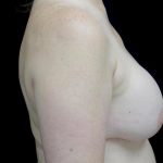 Breast Implant Removal (Explant Surgery) Before & After Patient #24626