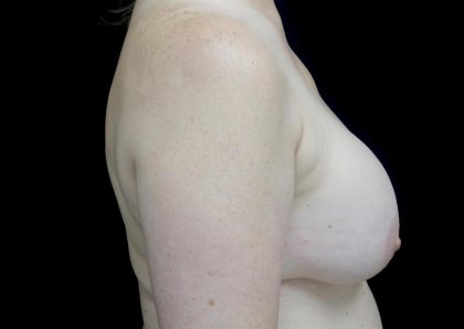Breast Implant Removal (Explant Surgery) Before & After Patient #24626