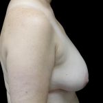 Breast Implant Removal (Explant Surgery) Before & After Patient #24626