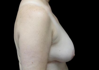 Breast Implant Removal (Explant Surgery) Before & After Patient #24626