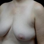 Breast Implant Removal (Explant Surgery) Before & After Patient #24626