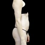 Tummy Tuck Before & After Patient #24618