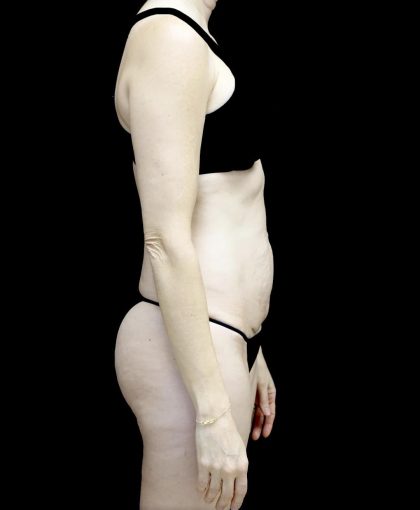 Tummy Tuck Before & After Patient #24618