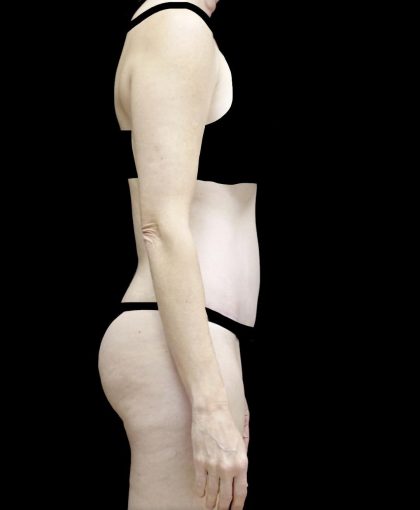 Tummy Tuck Before & After Patient #24618