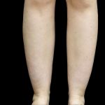 Liposuction Before & After Patient #24627