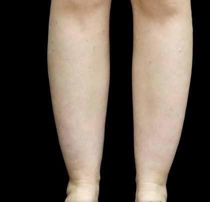 Liposuction Before & After Patient #24627