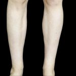 Liposuction Before & After Patient #24627