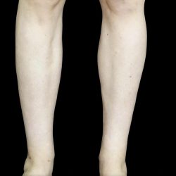 Liposuction Before & After Patient #24627