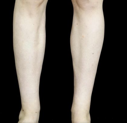 Liposuction Before & After Patient #24627