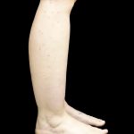 Liposuction Before & After Patient #24627