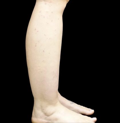 Liposuction Before & After Patient #24627