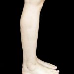 Liposuction Before & After Patient #24627