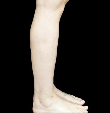 Liposuction Before & After Patient #24627