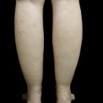 Liposuction Before & After Patient #24627