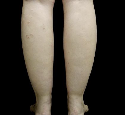 Liposuction Before & After Patient #24627