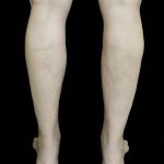 Liposuction Before & After Patient #24627