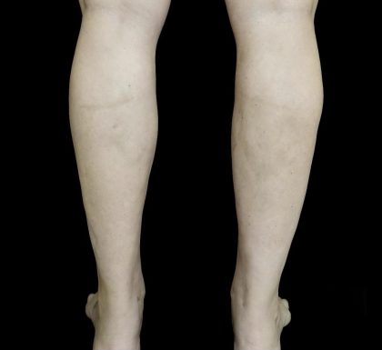 Liposuction Before & After Patient #24627
