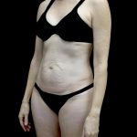 Tummy Tuck Before & After Patient #24618
