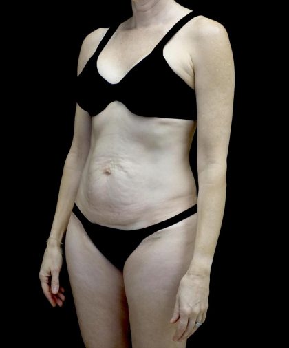 Tummy Tuck Before & After Patient #24618