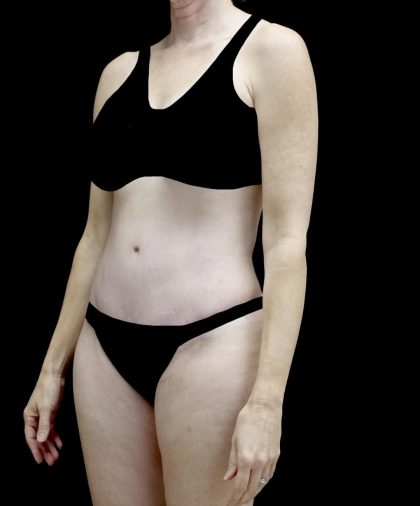 Tummy Tuck Before & After Patient #24618