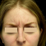 Botox/Dysport Before & After Patient #24691