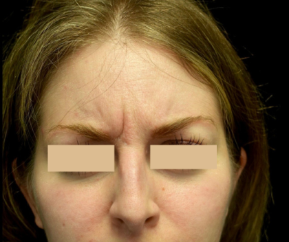 Botox/Dysport Before & After Patient #24691