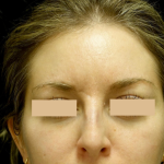 Botox/Dysport Before & After Patient #24691