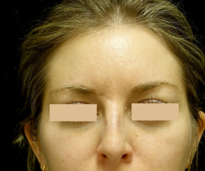 Botox/Dysport Before & After Patient #24691