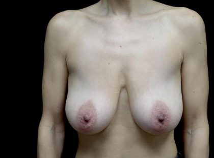 Breast Reduction Before & After Patient #24695