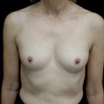 Breast Augmentation (Implants) Before & After Patient #24694