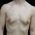 Breast Augmentation (Fat Transfer) Before & After Patient #24696