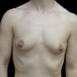 Breast Augmentation (Fat Transfer) Before & After Patient #24696