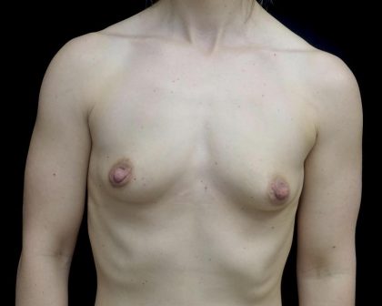 Breast Augmentation (Fat Transfer) Before & After Patient #24696