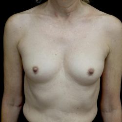 Breast Augmentation (Implants) Before & After Patient #24694